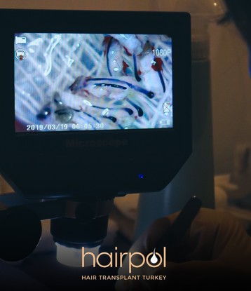 Follicular units magnified on a microscope screen during graft preparation