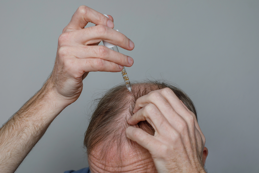 Diffuse thinning visible under overhead light on the top of the scalp