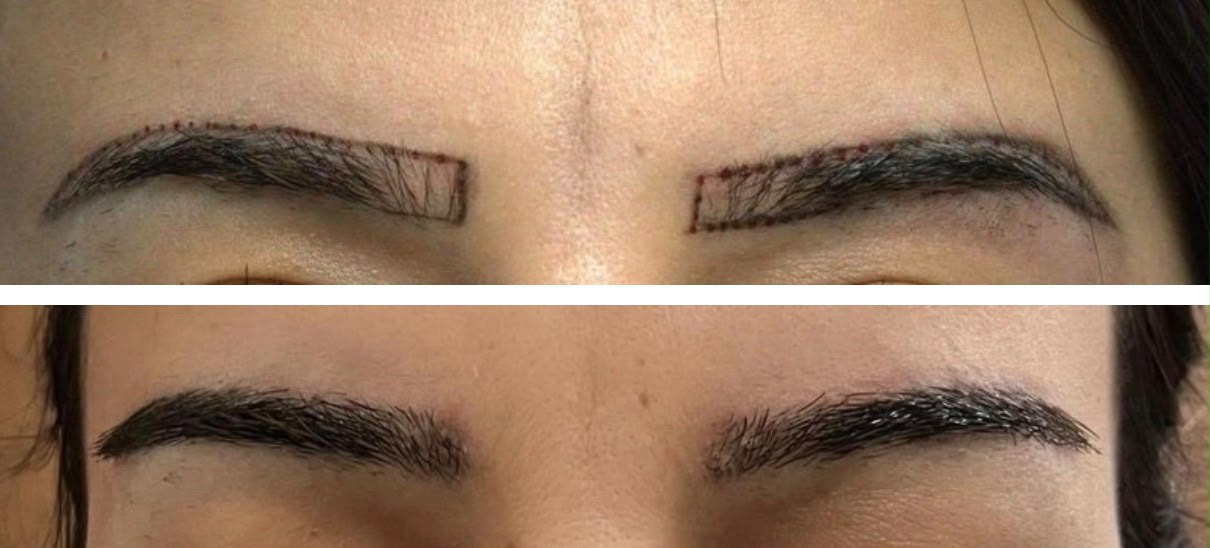 Eyebrow transplant before and after, planning markings and healed result