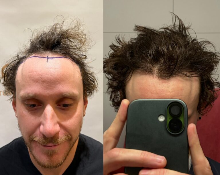3,513 Grafts Hair Transplant: 12 Month Result