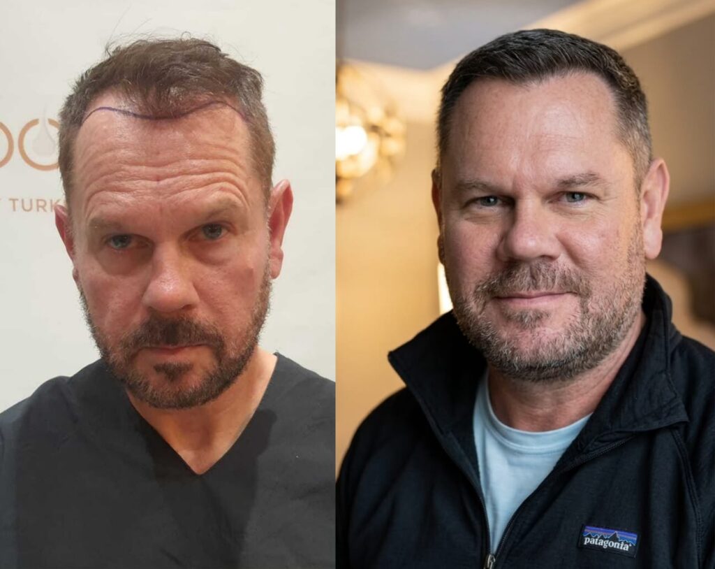 3550 graft hair transplant before after
