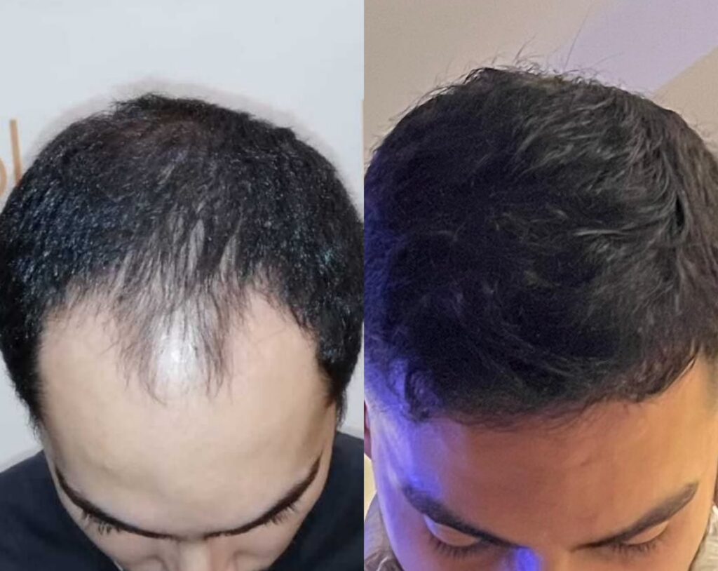 4000 graft hair transplant before after