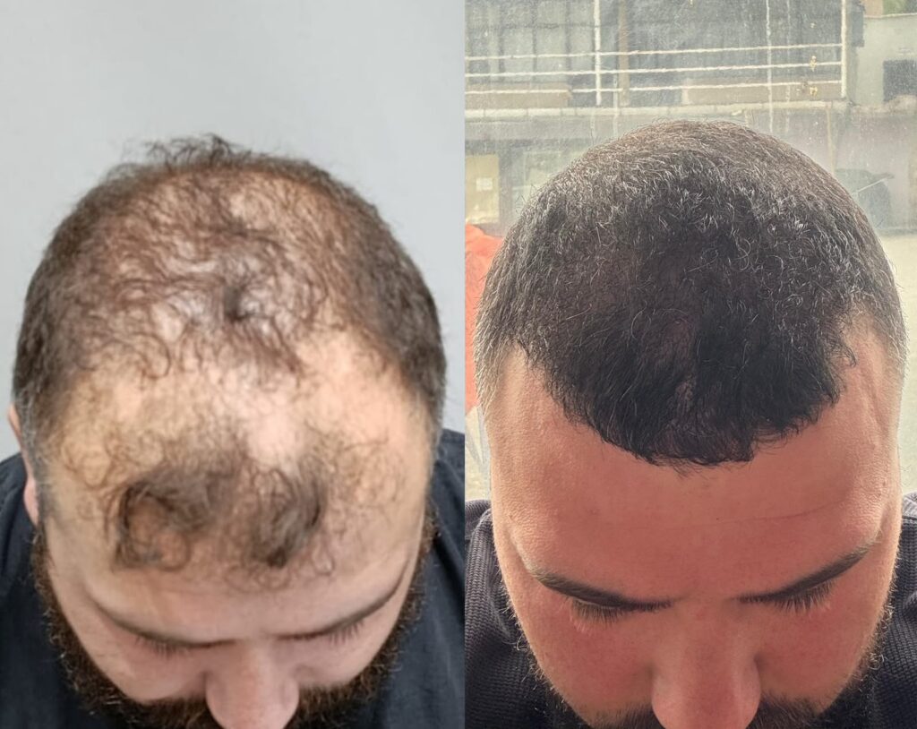 4250 graft hair transplant before after