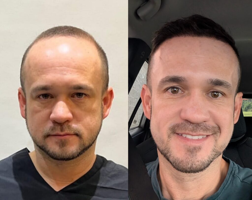 5000 graft hair transplant before after